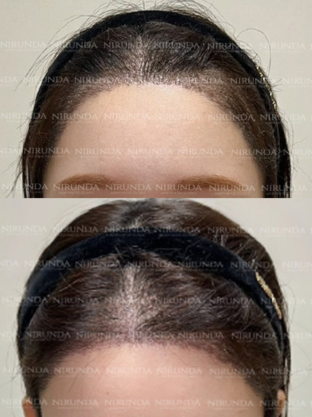 After Hair Transplant